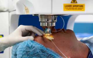 ФРК операция на глаза: метод проведения лазерной коррекции и восстановления после процедуры для улучшения зрения