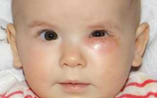 У новорожденного гноится глазик – что делать, причины и лечение, советы специалистов