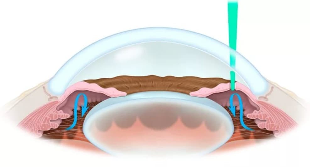Лазерная иридэктомия
