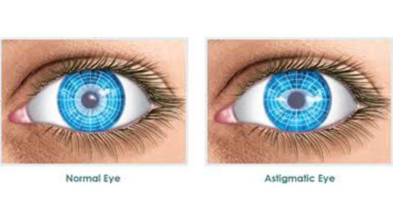 Преломление света при астигматизме