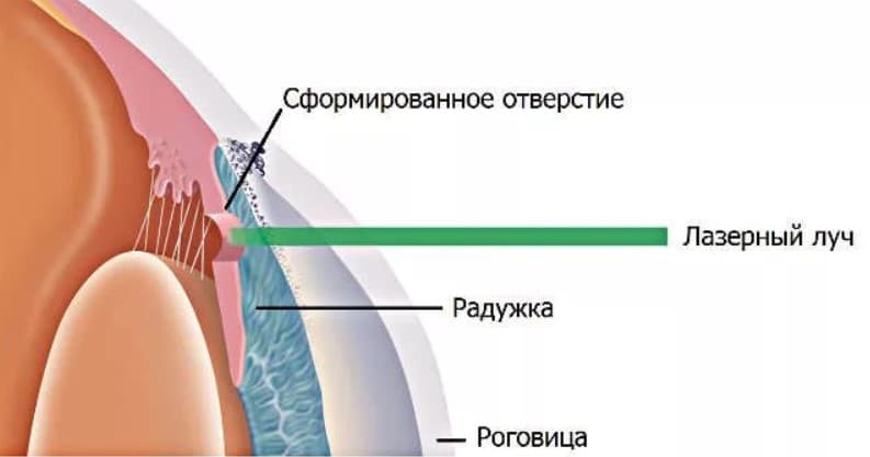 Схема проведения лазерной иридэктомии