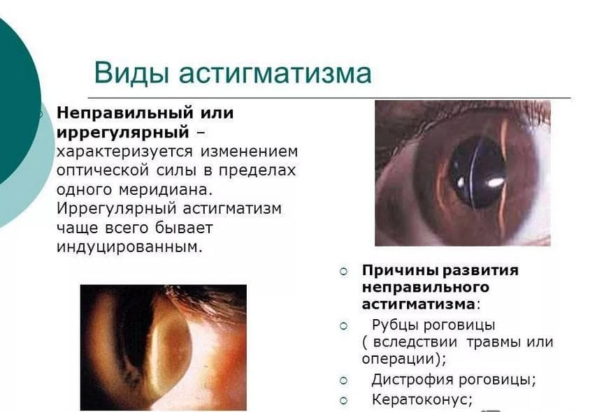 Виды астигматизма
